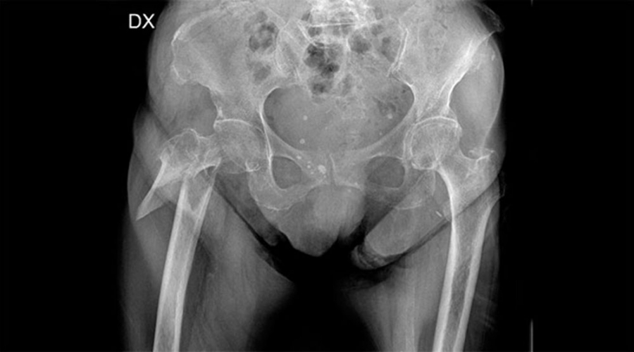Frattura del femore, più infezioni se il paziente va in ipotermia