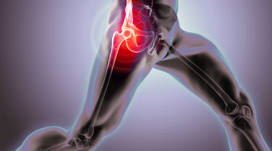 Pillole di Ortopedia - Artrosi dell'anca