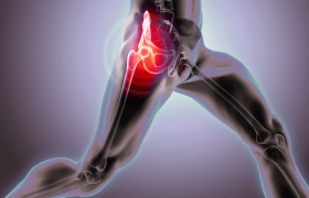 Pillole di Ortopedia - Artrosi dell'anca