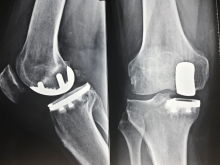 “What’s new” sull’intervento di protesi al ginocchio